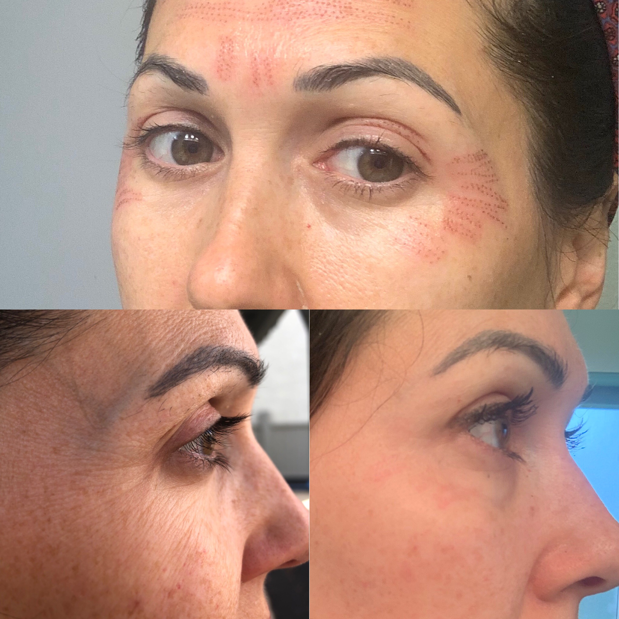 Plasma Lift Skin Tightening New Mexico